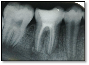 <p>Endodontic Obturation. This is a periapical radiograph showing the endodontic obturation of 46.</p>