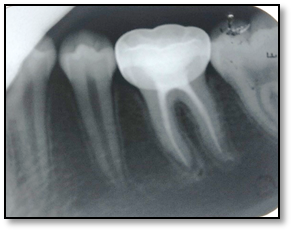 <p>Stainless Steel Crown, 1-Year Follow-Up. This radiograph shows a stainless steel crown of 46 at a 1-year follow-up.</p>