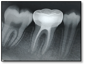 <p>Stainless Steel Crown, 2-Month Follow-Up