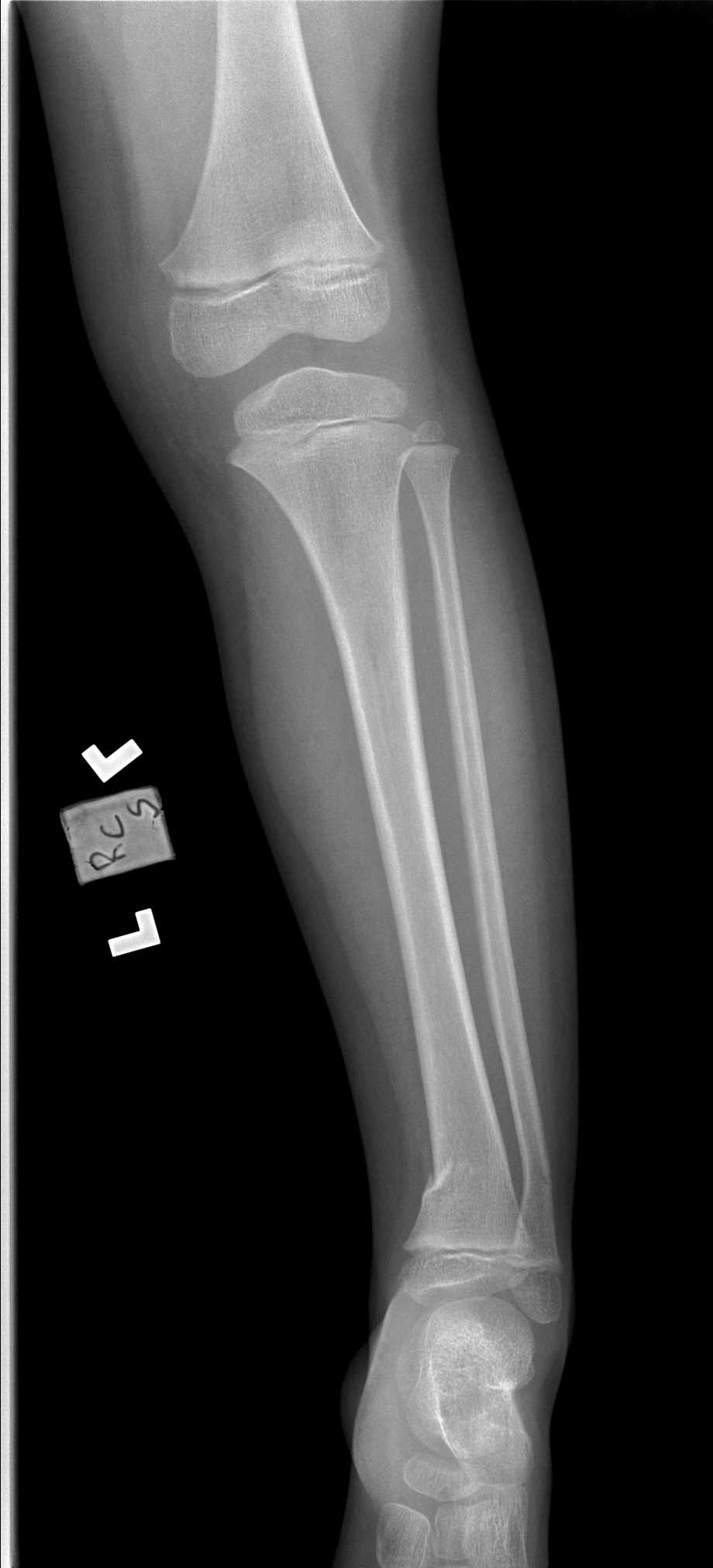 <p>Tibia Fibula Radiograph, Greenstick Fracture</p>