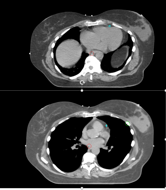 A comparison of a CT simulation scan comparing free-breathing (top) to a scan done in deep-inspiration breath-hold.