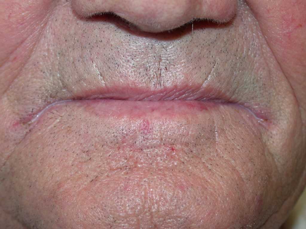 <p>Angular Cheilitis</p>