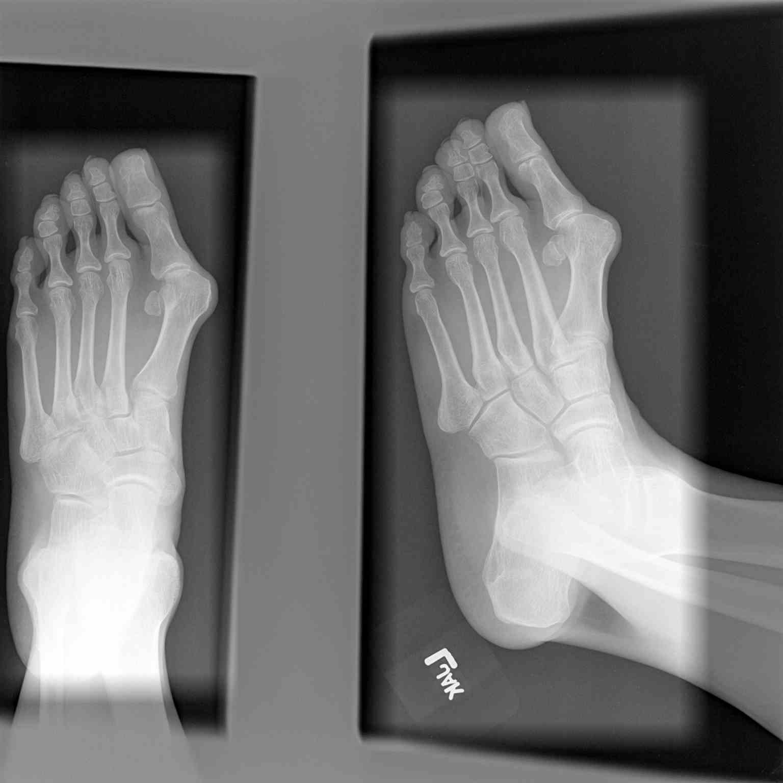 <p>Foot Radiograph, Hallux Valgus</p>