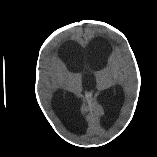 <p>Head CT,&nbsp;Hydrocephalus</p>