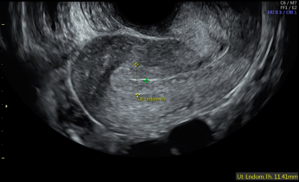 Figure 1: Sagittal view of uterus showing trilaminar endometrium,