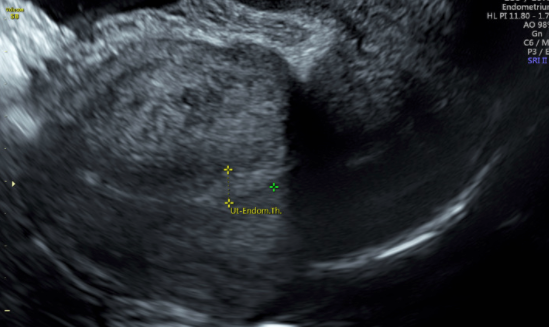 Figure 2: Sagittal view of uterus showing the luteal phase endometrium