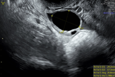 Figure 3: Transvaginal ultrasound image showing the ovary with a dominant follicle before ovulation trigger injection is admi