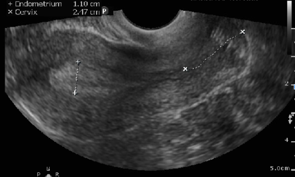 Figure 5: Midsagittal view of the uterus with its endometrium being measured perpendicularly from one echogenic to the other 