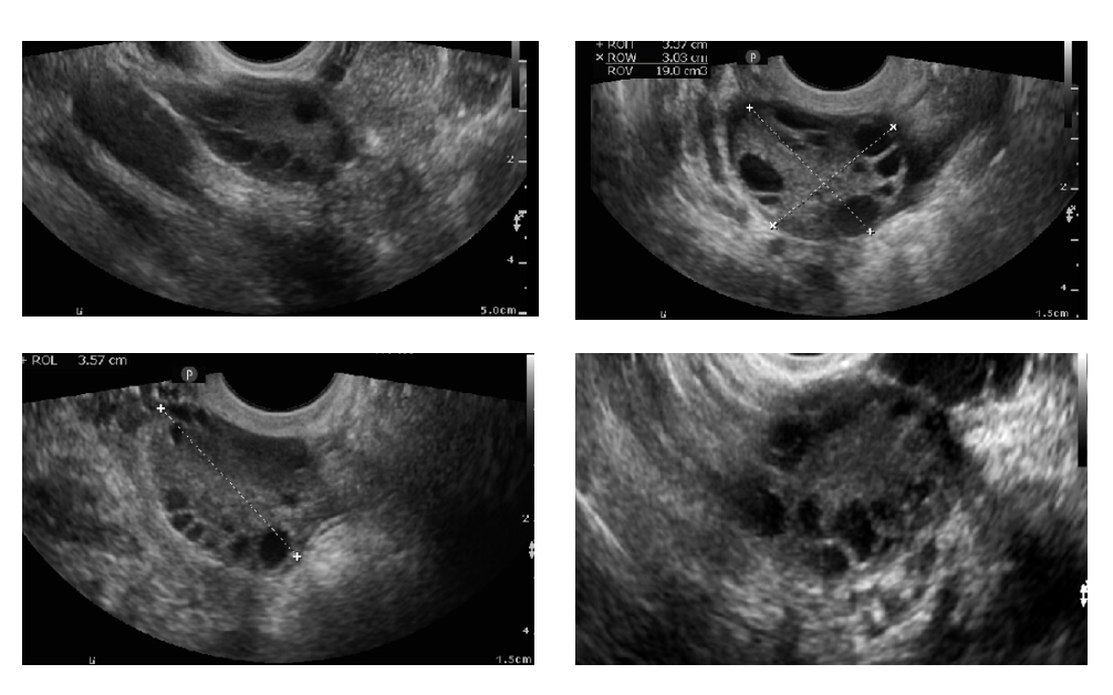 Figure 10: Transvaginal 2D scan showing polycystic ovaries