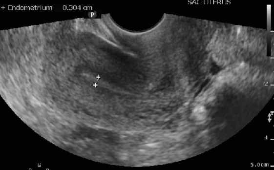 Figure 13: Transvaginal scan of uterus with thin endometrial stripe in a patient using Clomiphene Citrate (CC)