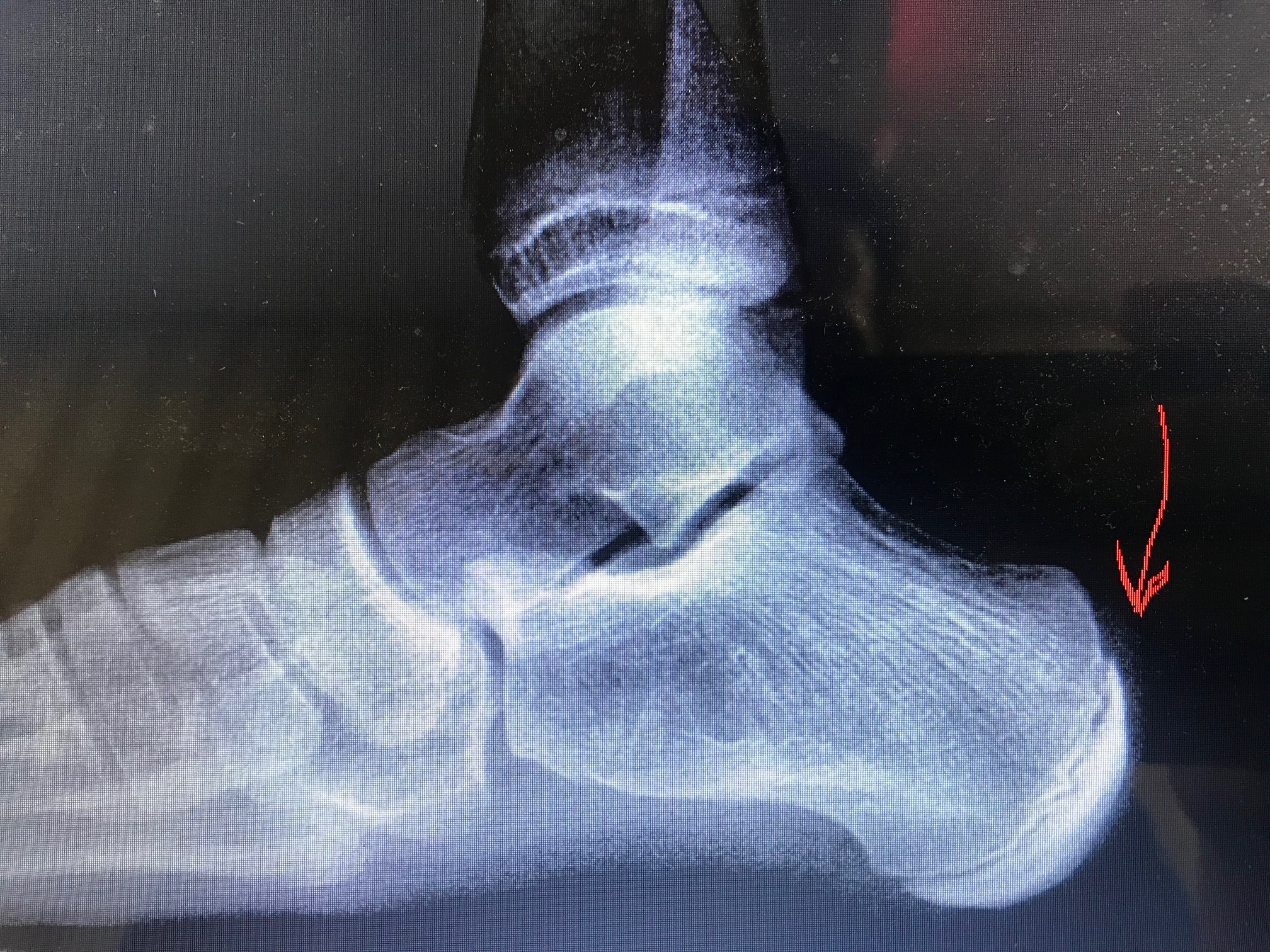 Severs Disease- calcaneal apophysitis in an adolescent