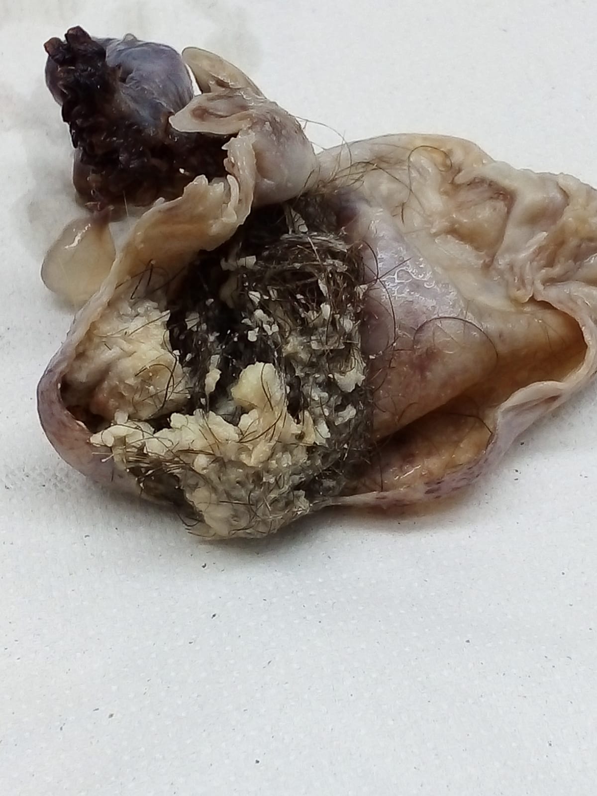 Dermoid cyst of the ovary