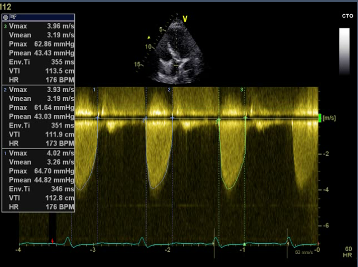 Figure.4
Continuous wave (CW) Doppler at aortic valve