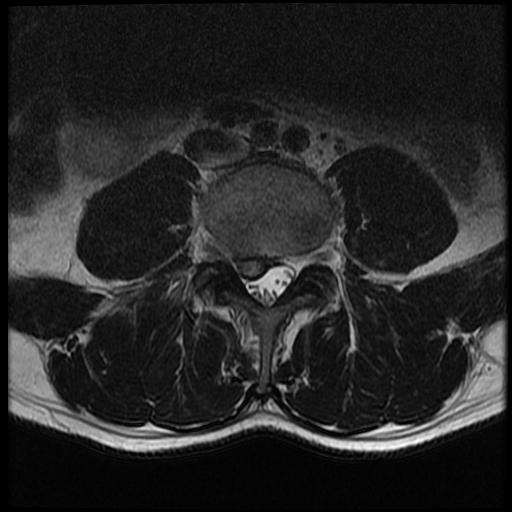 MRI Lumbar Spine Disc Herniation