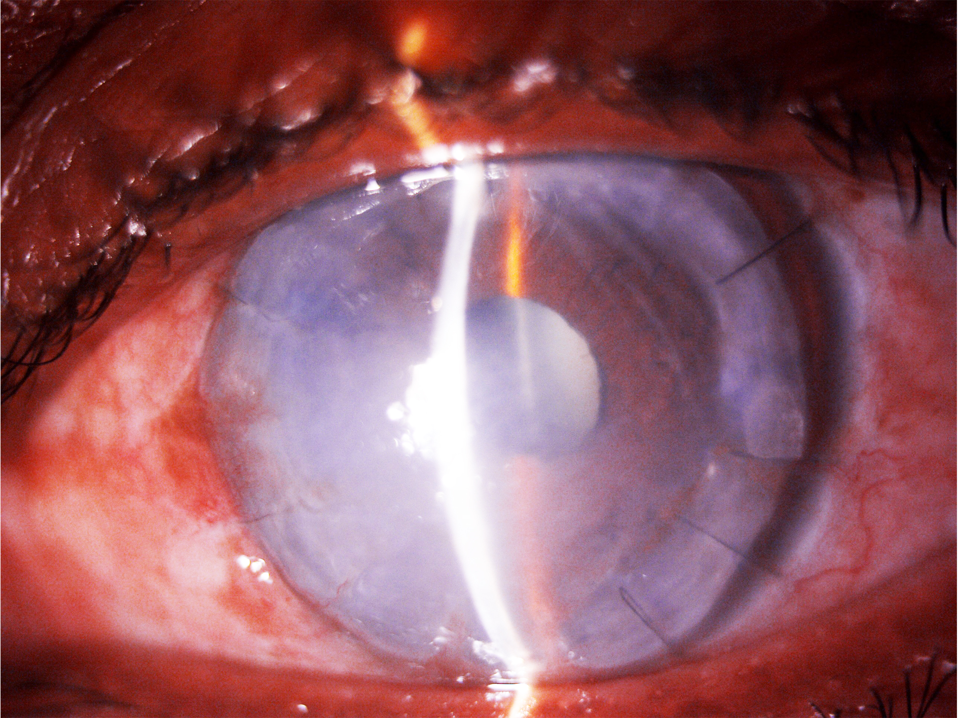 Figure 2- Slit lamp image of a patient of Pythium keratitis post Therapeutic keratoplasty. The image depicts mild conjunctival congestion, large 10 mm failed graft, graft host junction is well opposed with edge lift from 1 to 2 o clock, well formed anterior chamber with immature cataract