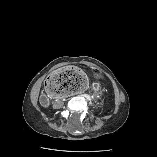 <p>Myelomeningocele Detected on CT Scan