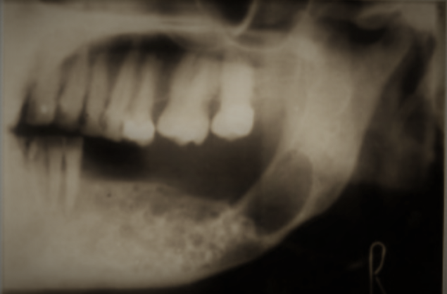 Fig. 1: Orthopantomogram of solid ameloblastoma of the mandible