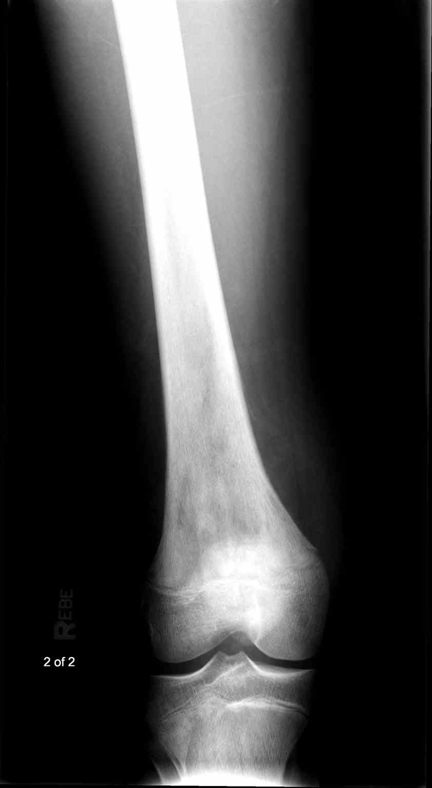 <p>&nbsp;Osteogenic Sarcoma