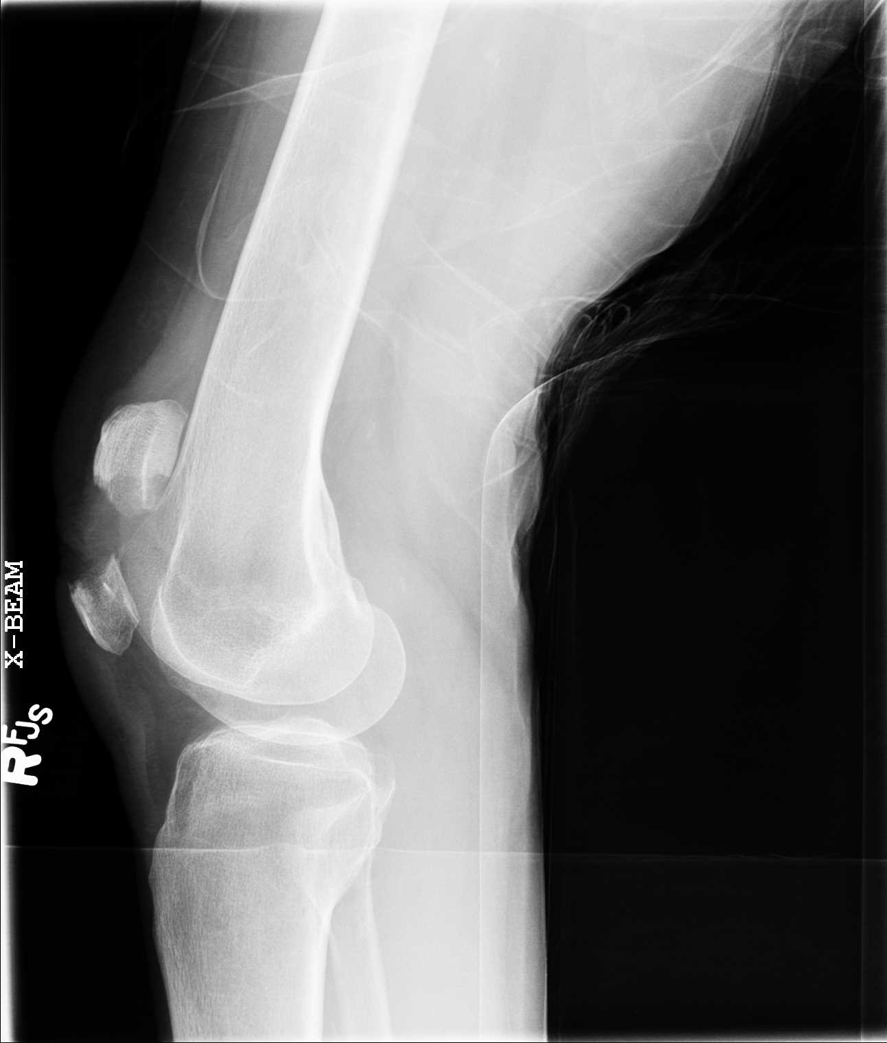 Knee Radiograph Patellar Fracture