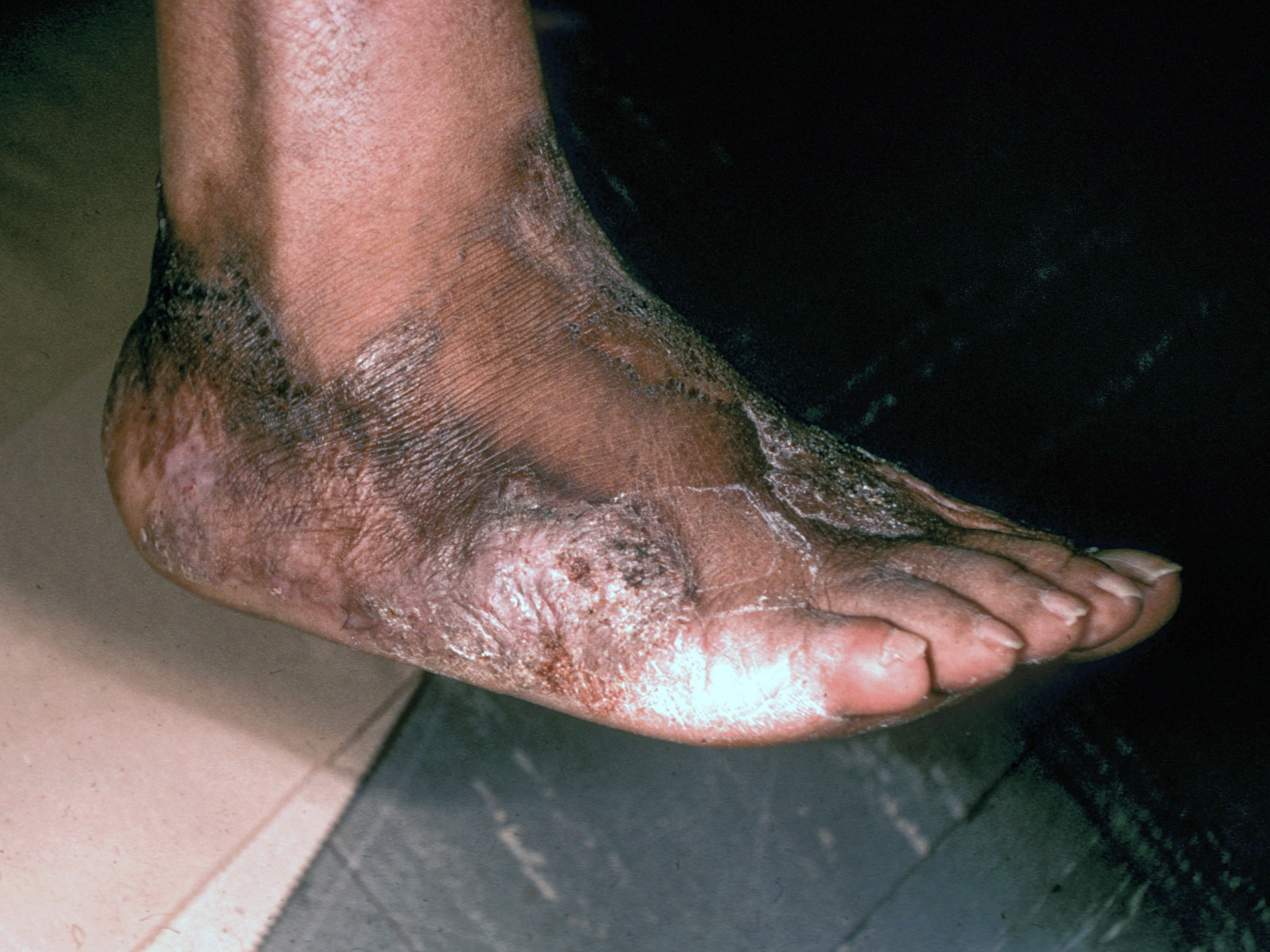 <p>Progressing Eumycetoma With Deep-Tissue Penetration