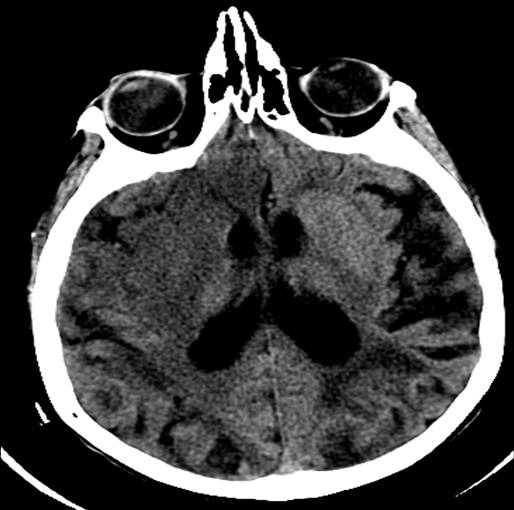 <p>Head CT,&nbsp;Right Middle Cerebral Artery Stroke</p>