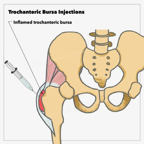 Trochanteric Bursitis Injection