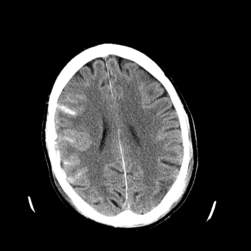 <p>Head CT, Subarachnoid Hemorrhage</p>