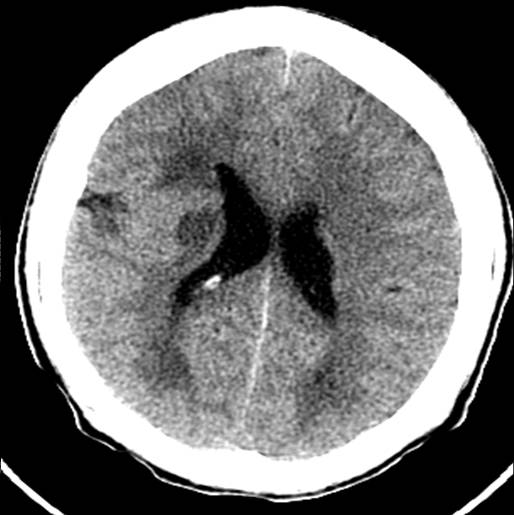 <p>Head CT, Schizencephaly</p>