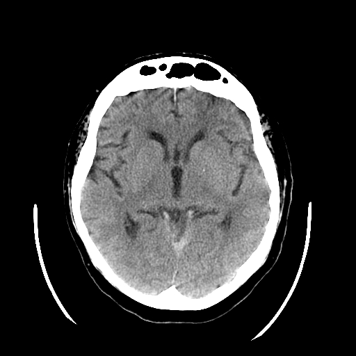 CT Head Subdural Hematoma Tentorium