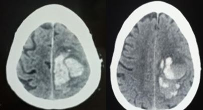 Cortical venous thrombosis with hemorrhagic transformation