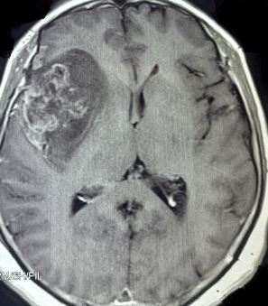 Glioblastoma multiforme