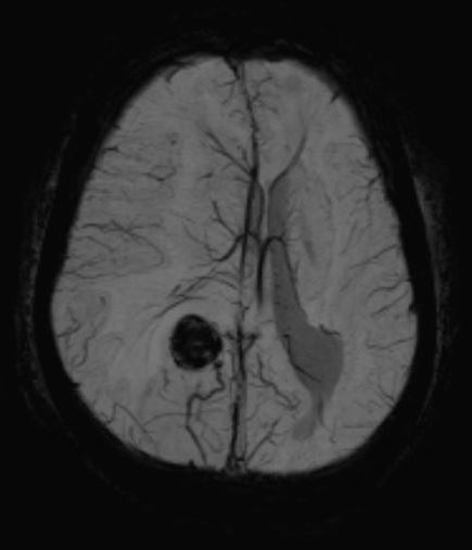 SWI sequence in cortical cavernoma