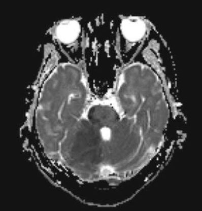 <p>Cerebellar Infarction on Magnetic Resonance Imaging. Note the area of hypointensity on the right cerebellum.</p>