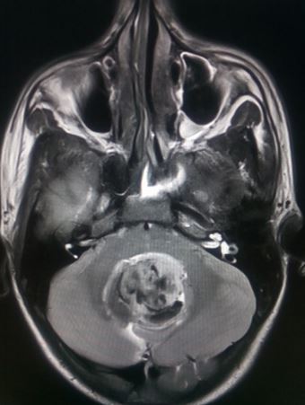 Medulloblastoma