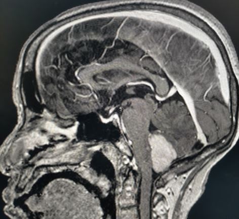 Ependymoma