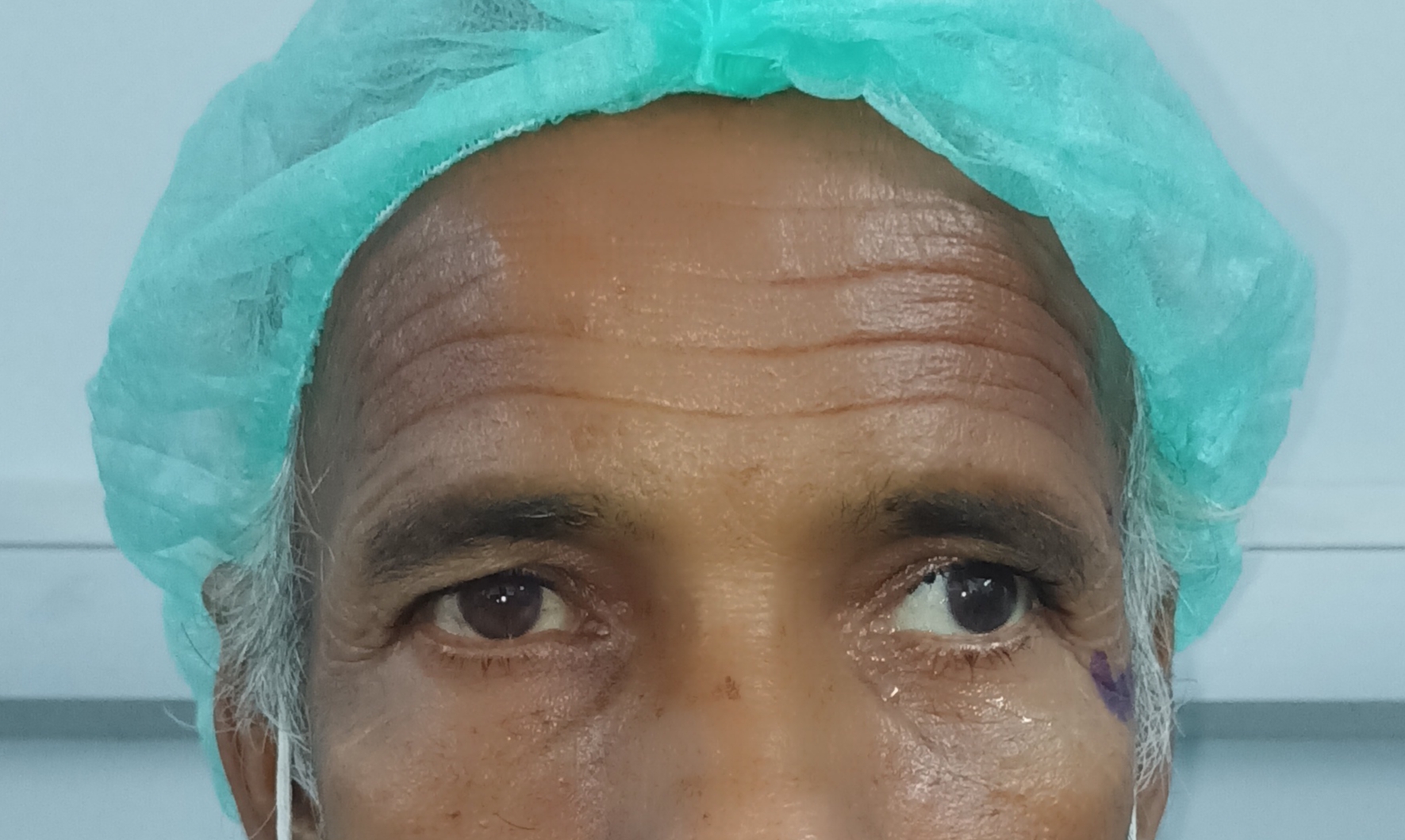 Image of  the patient depicting 20 degree exotropia along with 10 degree hypertropia in the left eye in primary gaze