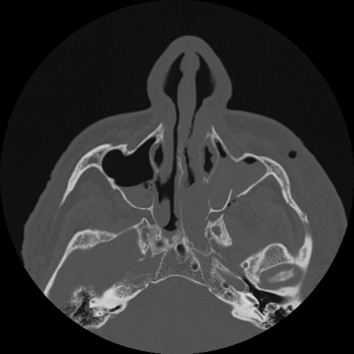 <p>Face CT, Tripod Fracture</p>