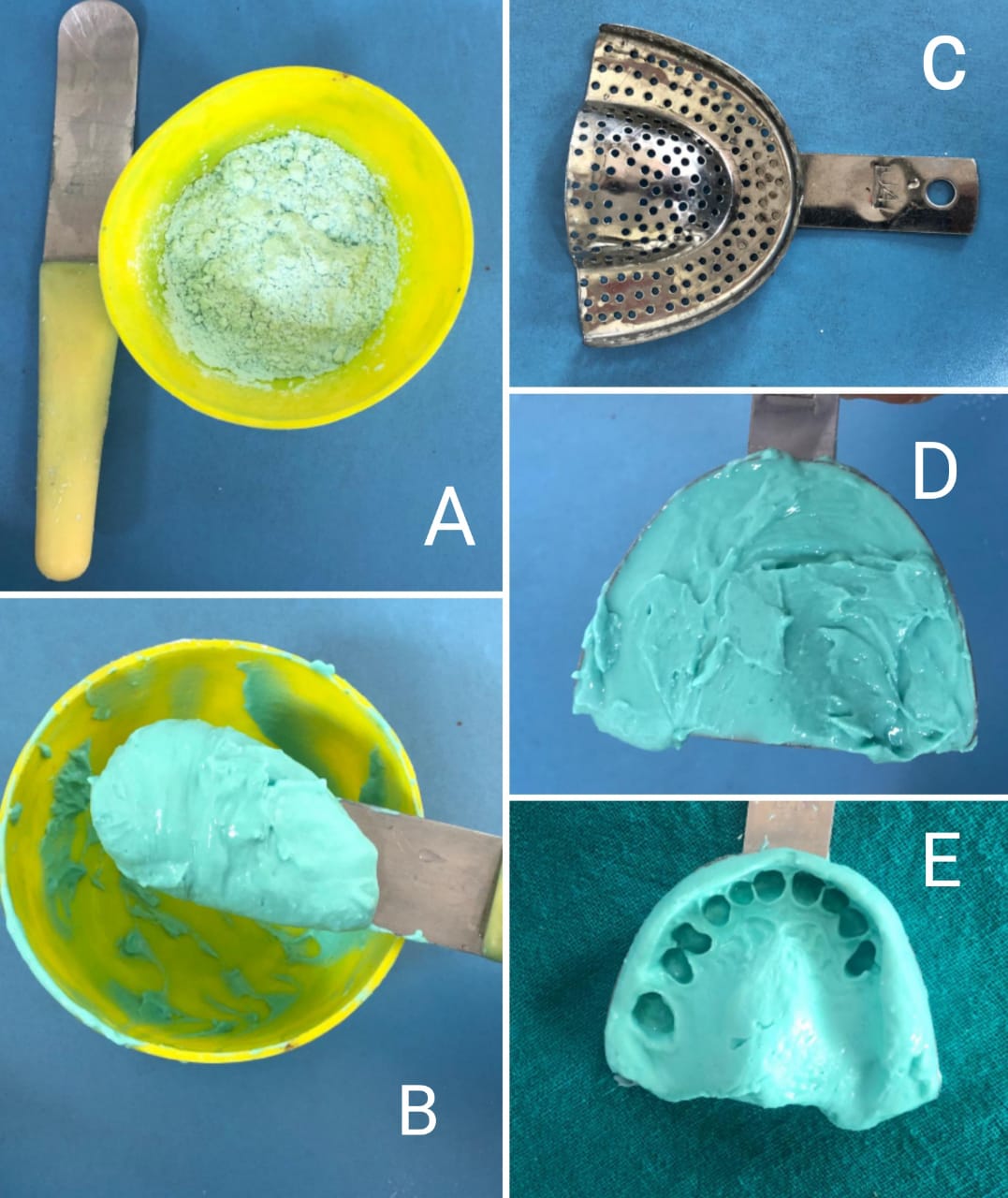 <p>Alginate, Impression Making