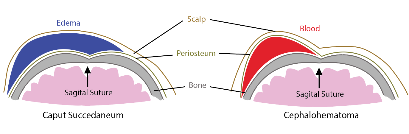 Caput Succedaneum vs. Cephalohematoma fluid collection