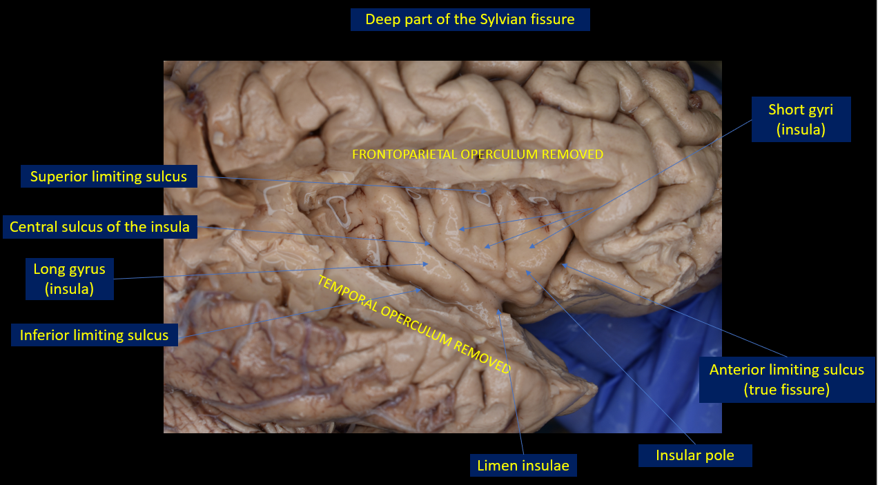Figure 3. Deep part of the Sylvian fissure. The temporal and frontoparietal opercula have been removed exposing the lateral surface of the insula. The superior, inferior, and anterior limiting sulci form the circular sulcus of the insula. The anterior limiting sulcus is a true fissure between the anterior surface of the insula and the posterior surface of the posterior orbital gyrus. The lateral surface of the insula is divided by the central sulcus of the insula in anterior and posterior regions. The anterior region is composed of the short gyri and the posterior region of the long gyri. The limen insulae is the prominence of the uncinate fasciculus in the anteroinferior portion of the lateral insula. It communicates the sphenoidal and operculoinsular compartments, the two compartments of the deep part of the Sylvian fissure.
