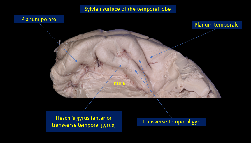 Figure 5. Sylvian surface of the temporal lobe. The Sylvian surface of the temporal lobe is the floor of the deep Sylvian fissure. It is part of the operculoinsular compartment forming the lower lip of the opercular cleft and the inferior limb of the insular cleft. The planum polare is the smooth area free of gyri located anteriorly. It contains a shallow trough for the middle cerebral artery course. The planum temporale is a triangular area located posteriorly. It is composed of the transverse temporal gyri. The anterior transverse temporal gyrus is called Heschl’s gyrus. The planum temporale has a horizontal orientation while the planum polare slopes downward from lateral to medial.