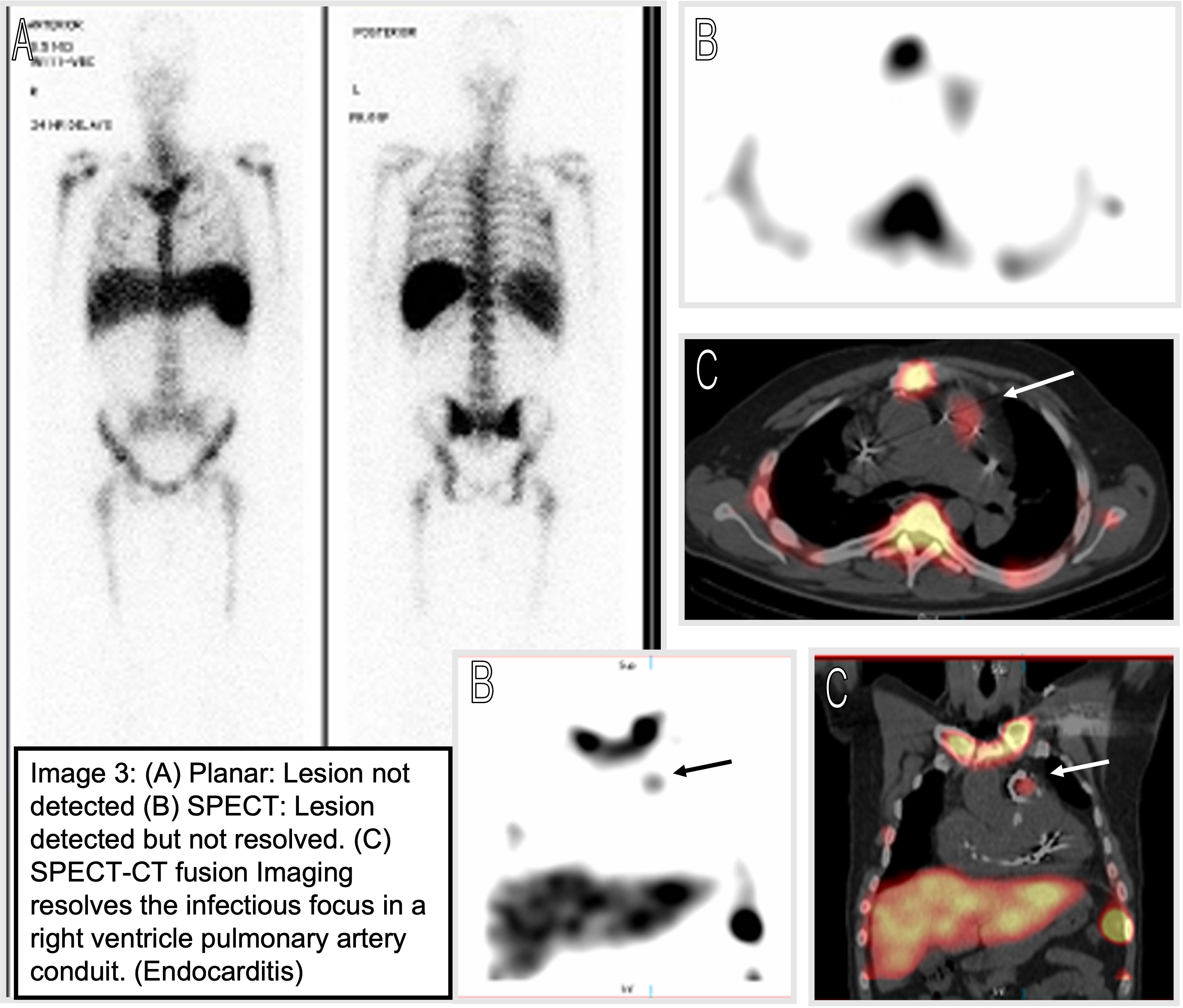 Endocarditis