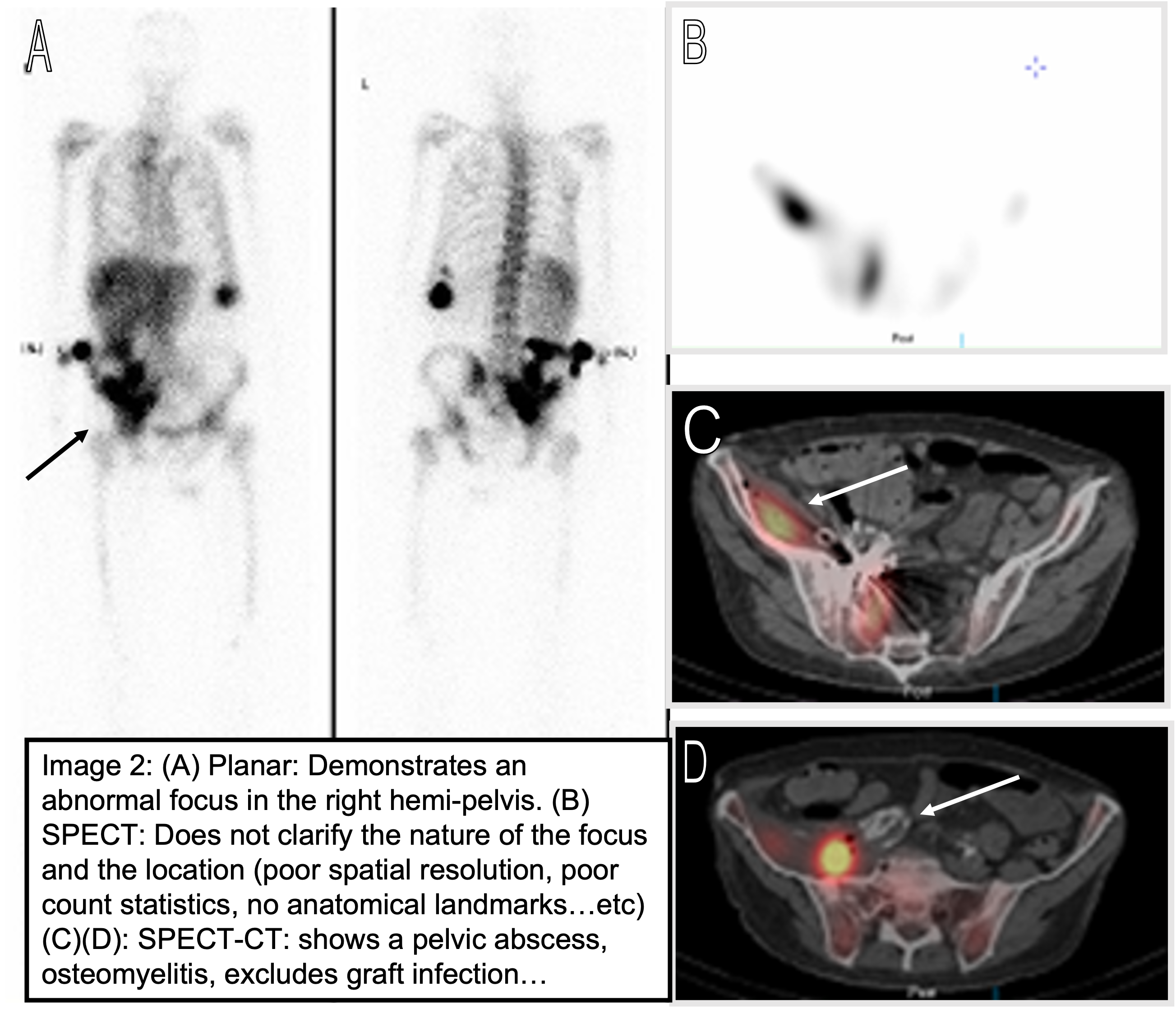 white blood cell scan with SPECT-CT