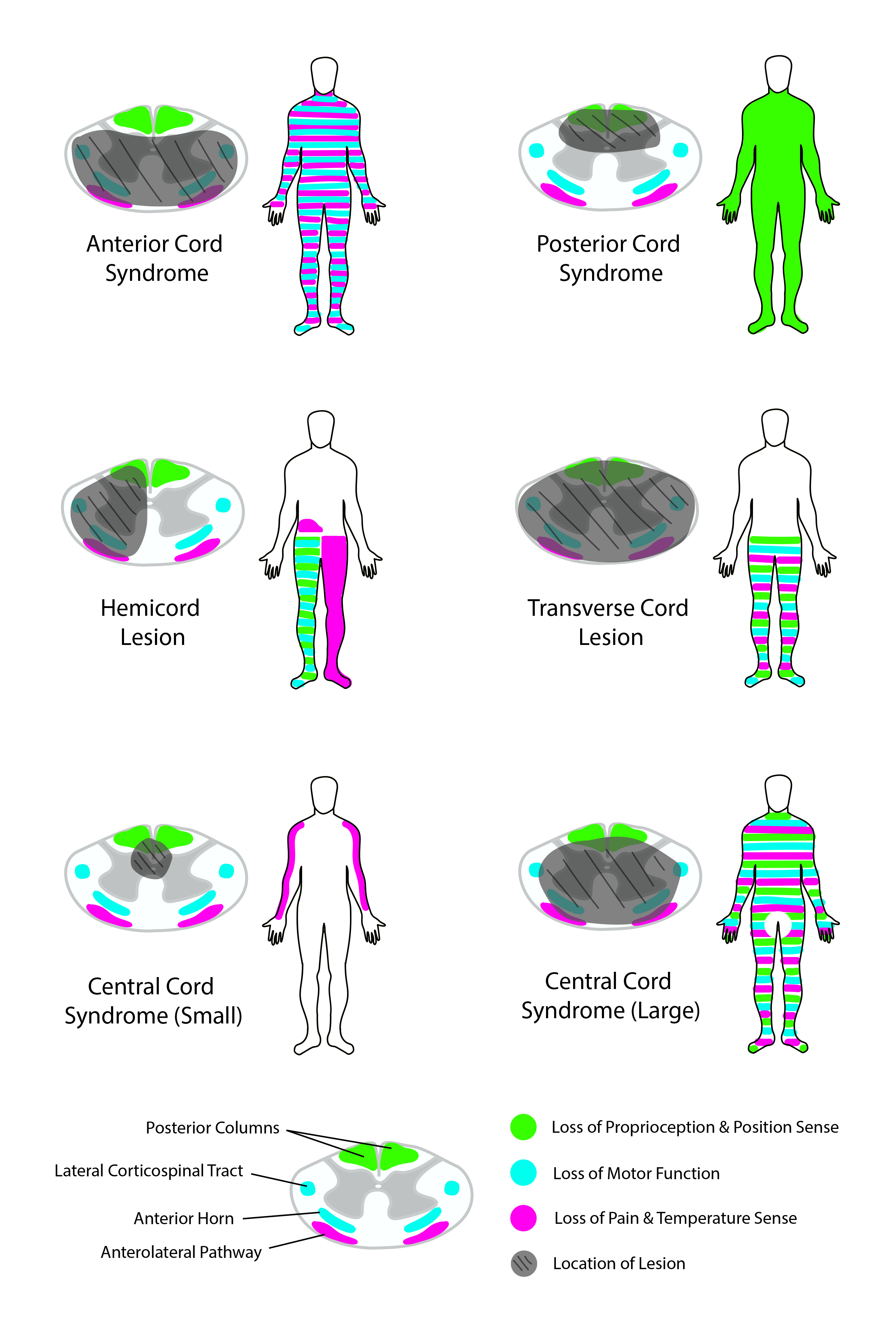 Comparison of spinal cord lesions and syndromes with corresponding sensory/motor deficits.