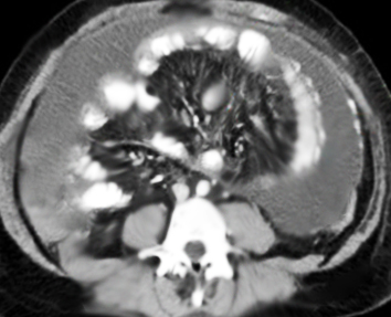 <p>Encapsulating Peritoneal Sclerosis on CT Abdomen/Pelvis</p>