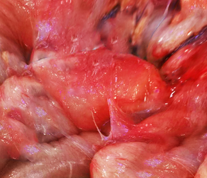 <p>Gross Image of Encapsulating Peritoneal Sclerosis</p>