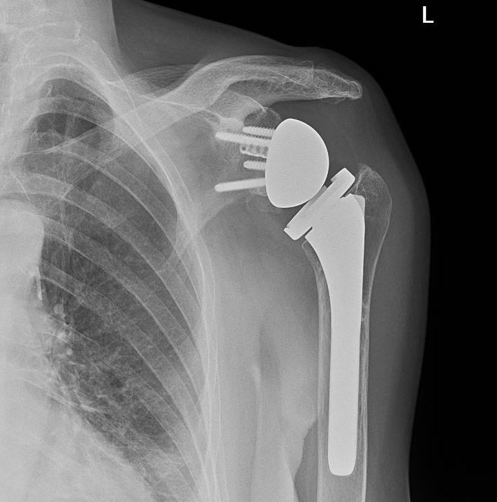 <p>Reverse Total Shoulder Arthroplasty