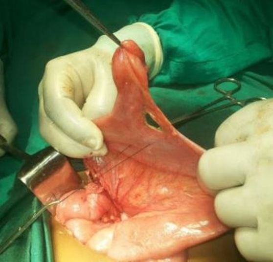 Meckel diverticulum along with its supplying artery