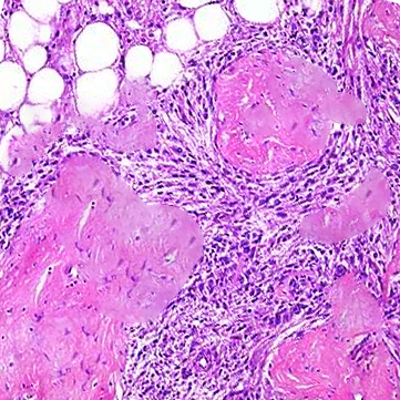 <p>Histology, Renal Angiomyolipoma</p>