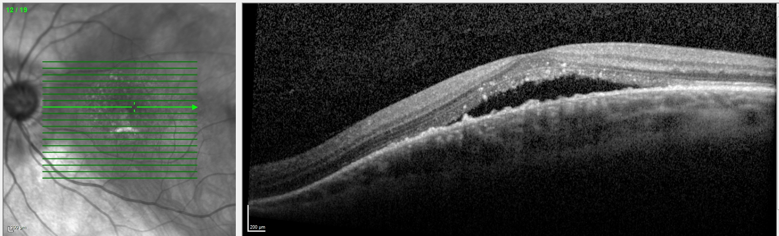 <p>Dome-Shaped Maculopathy With Subretinal Fluid